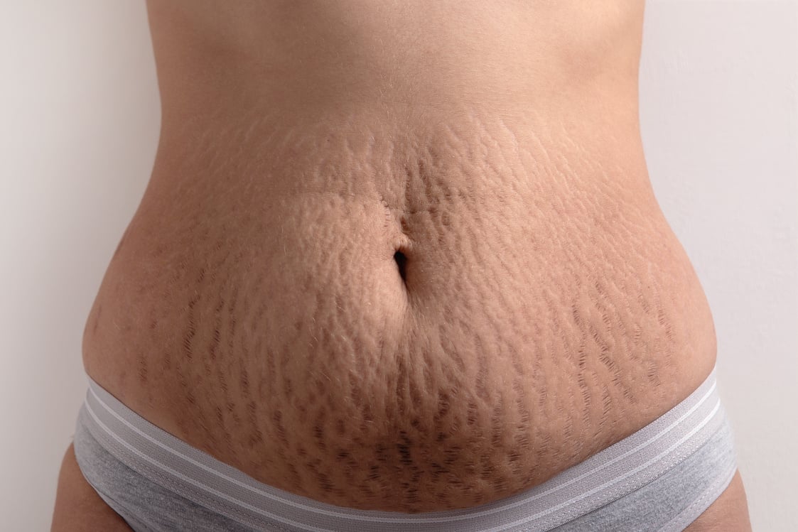 Woman's Stomach with Striae 